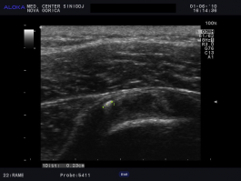 Ultrazvok rame - kalcinacija v tetivi supraspinatusa, indikacija za ESWT 2